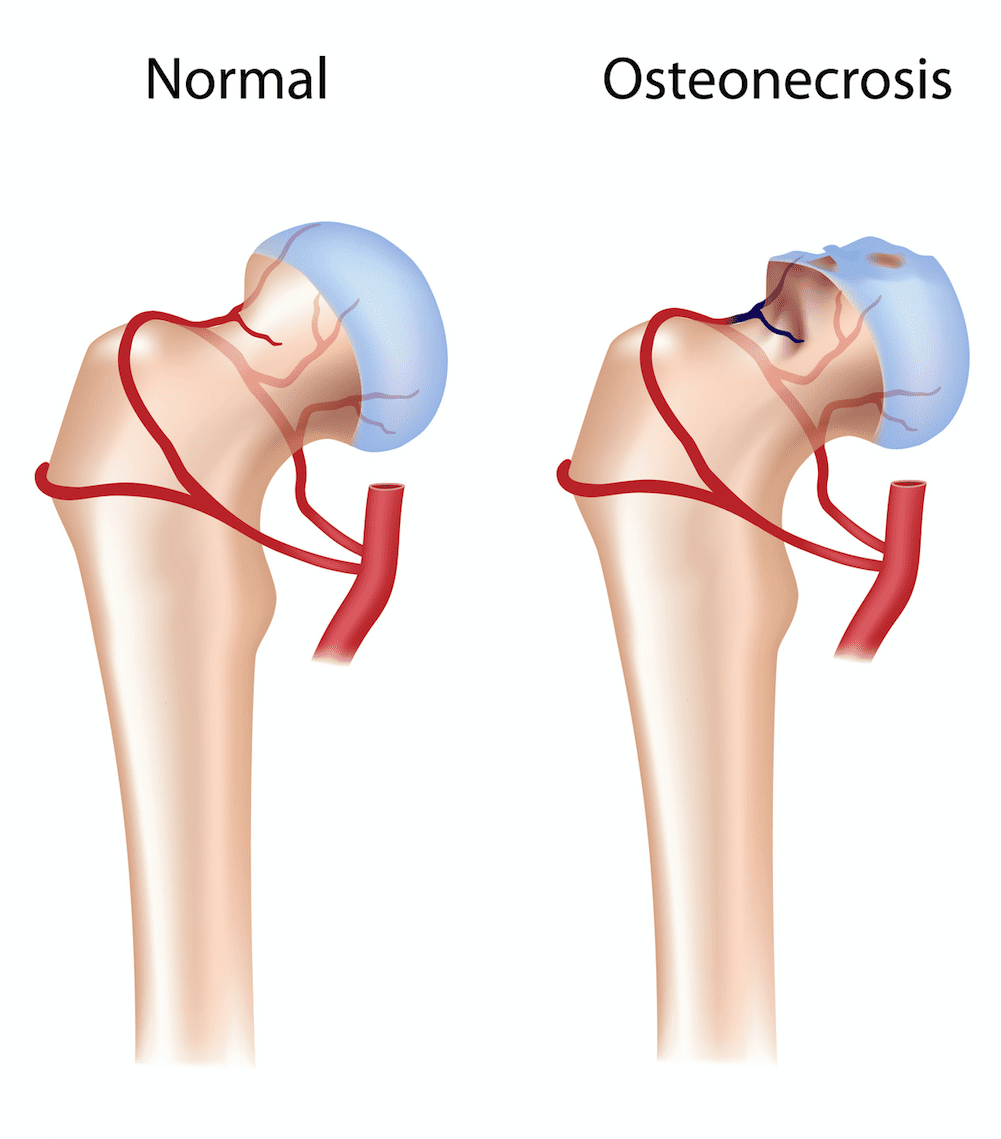 Osteonecrosis of Hip